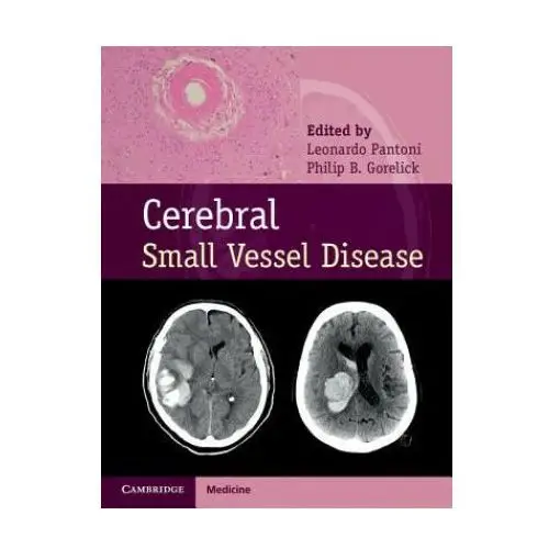 Cerebral small vessel disease Cambridge university press