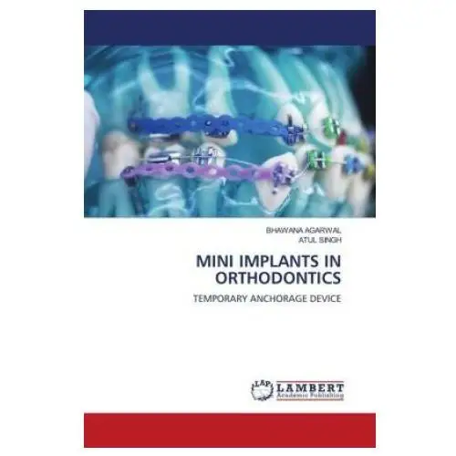 Mini implants in orthodontics Lap lambert academic publishing