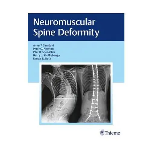 Neuromuscular spine deformity Thieme medical publishers inc