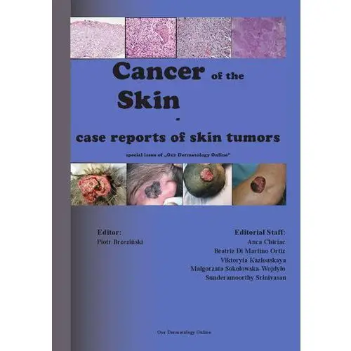 Cancer of the skin - case reports of skin tumors