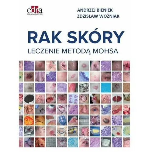 Rak skóry. Leczenie metodą Mohsa