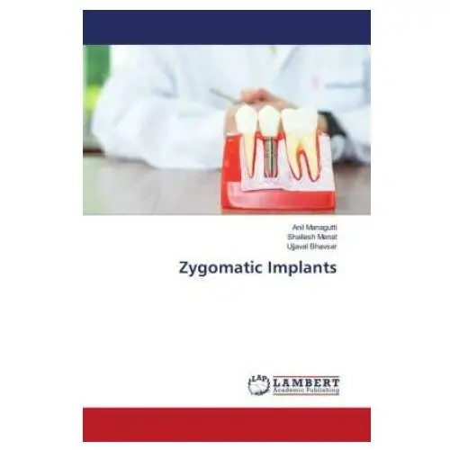 Zygomatic Implants